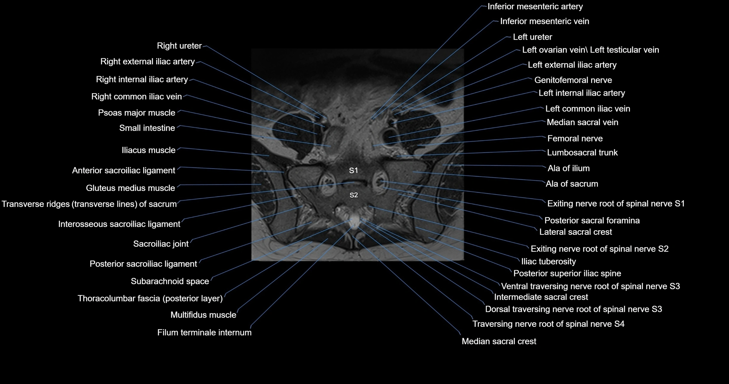 MRI lumbar spine axial cross sectional anatomy 3T radiology  image-img-00001-00047.webp
